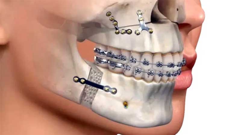 Çene Cerrahisi Uygulamaları Nelerdir?