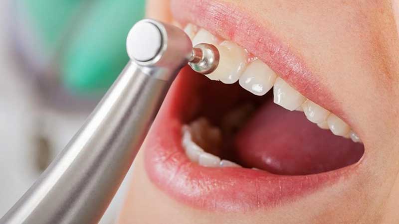 Diş Taşı Nedir? Diş Taşı Temizliği Zararlı mıdır?