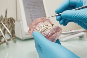 Diş Teli mi Yoksa Şeffaf Plak mı Daha İyi Sonuç Verir?