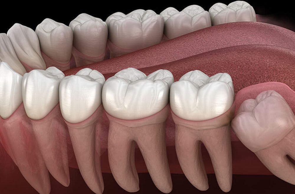 nisantasi-yirmi-yas-dis-tedavisi