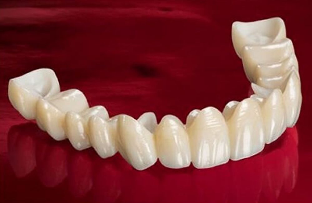 porselen-kuron-dis-kaplama