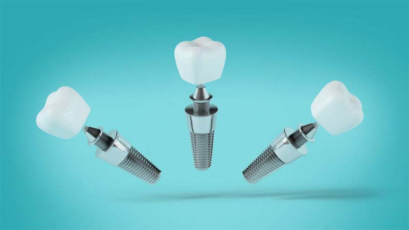 Hızlı İmplant Nasıl Yapılır?