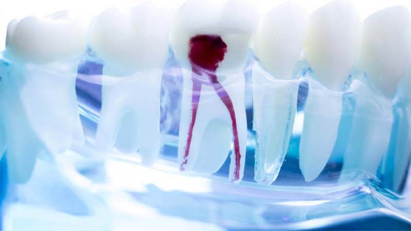 Kanal Tedavisi (Endodonti) Nedir? Nasıl Yapılır? Nelere Dikkat Etmek Gerekir?