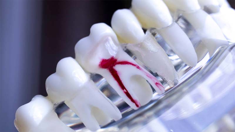 Kanal Tedavisi Öncesi ve Sonrası Nelere Dikkat Gerekir?